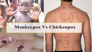 difference between chickenpox and monkeypox